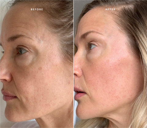 Before and after skin results