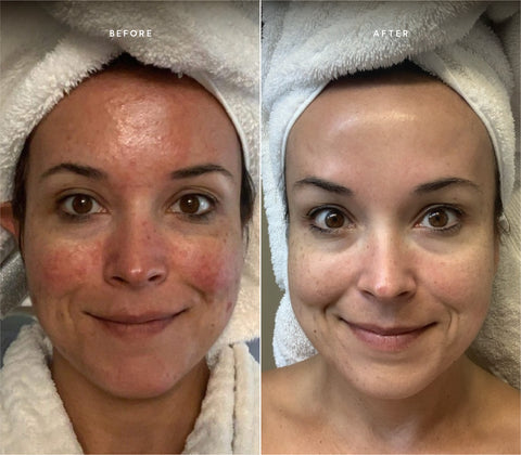 Before and after skin results